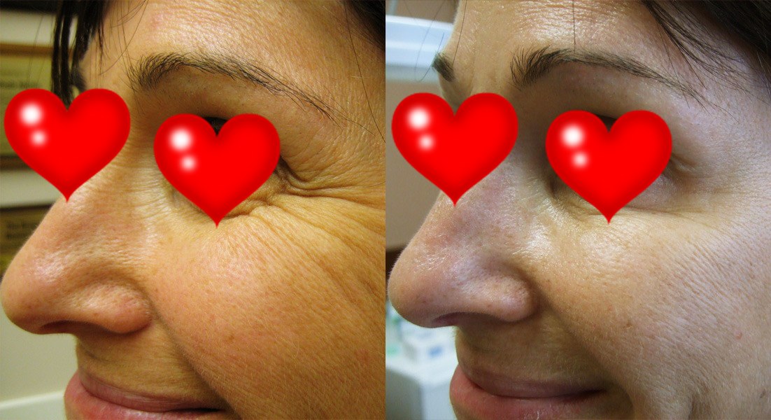 Fillers for Crow's Feet Before and After Botox Brow Lift